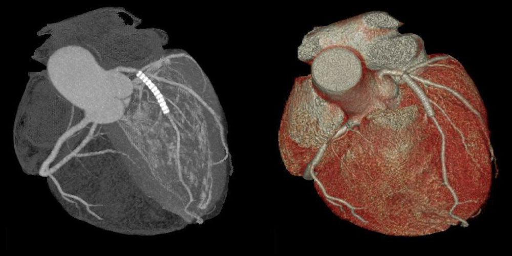 心臓冠動脈造影