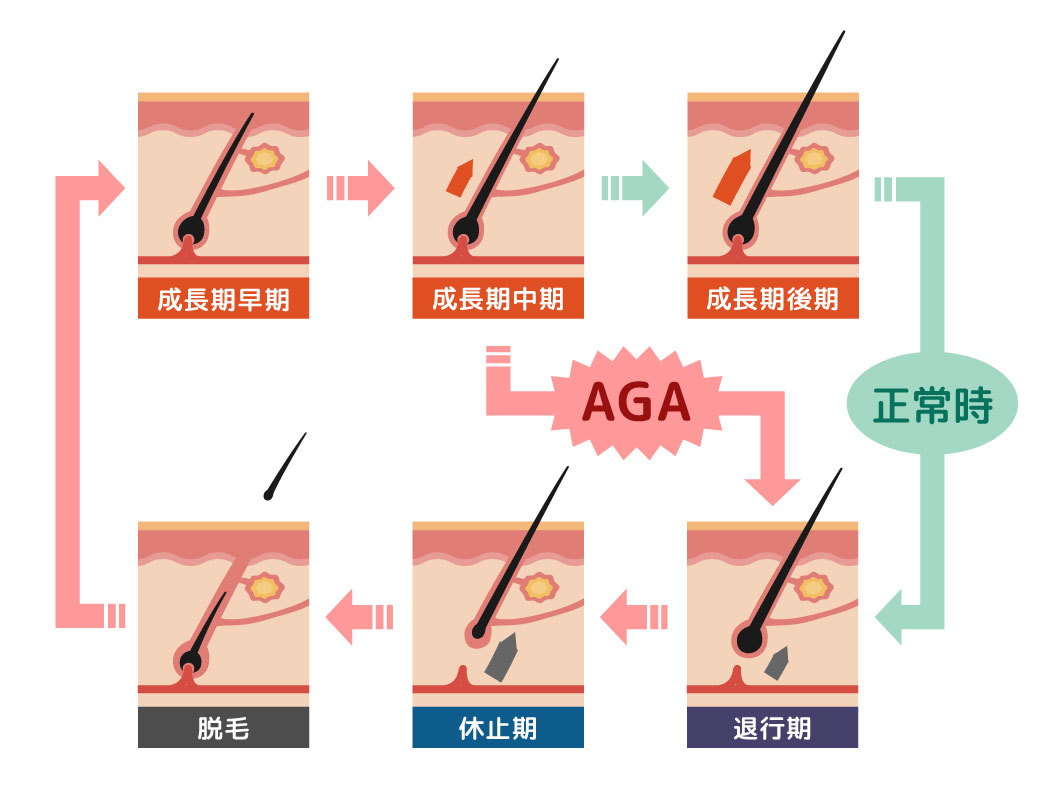 AGAの原因